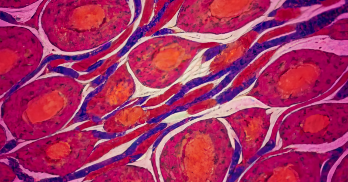 pancreatic Cancer in mysoore: Symptoms, Causes, and Treatment